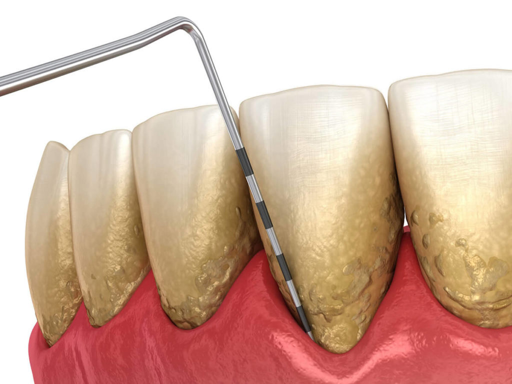 illustration of teeth with gum disease and receding gums