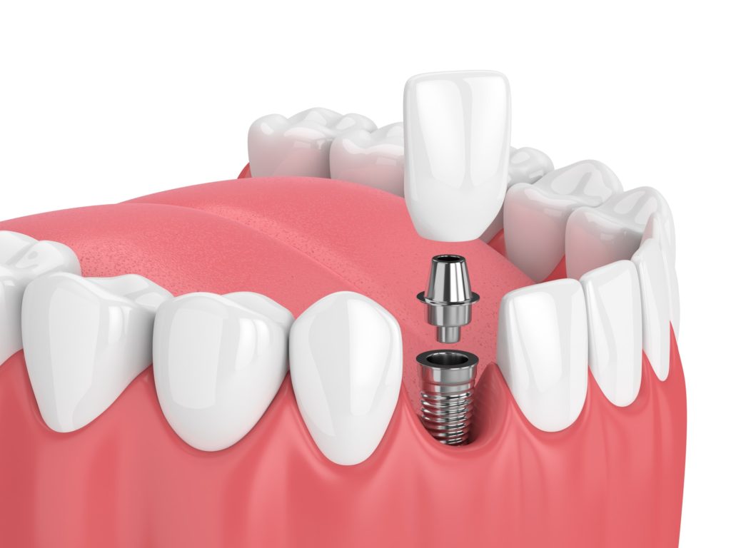 Summit Family Dentistry Denver_North Carolina_Dental_Implants