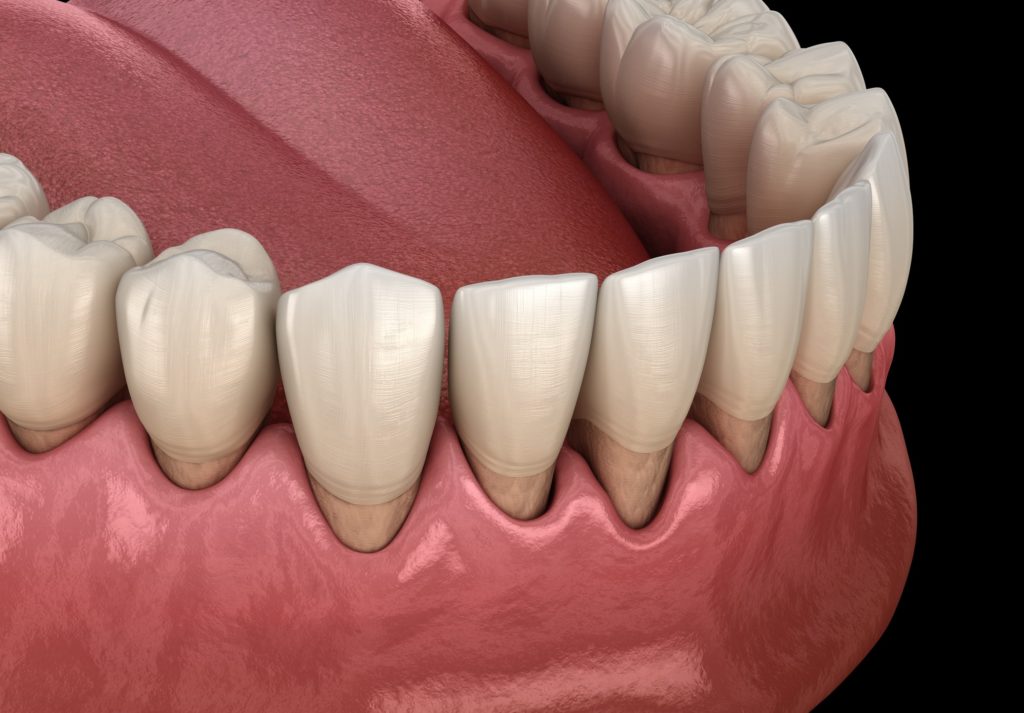 Summit Family Dentistry Periodontal disease Gum disease