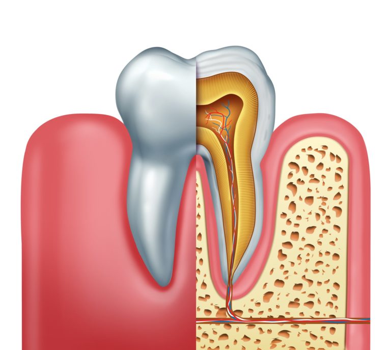 illustration of a tooth needing a root canal
