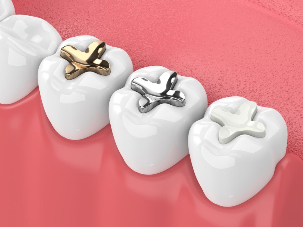 Image to Represent Tooth Fillings and Sealants Available From Summit Family Dentistry Denver, North Carolina