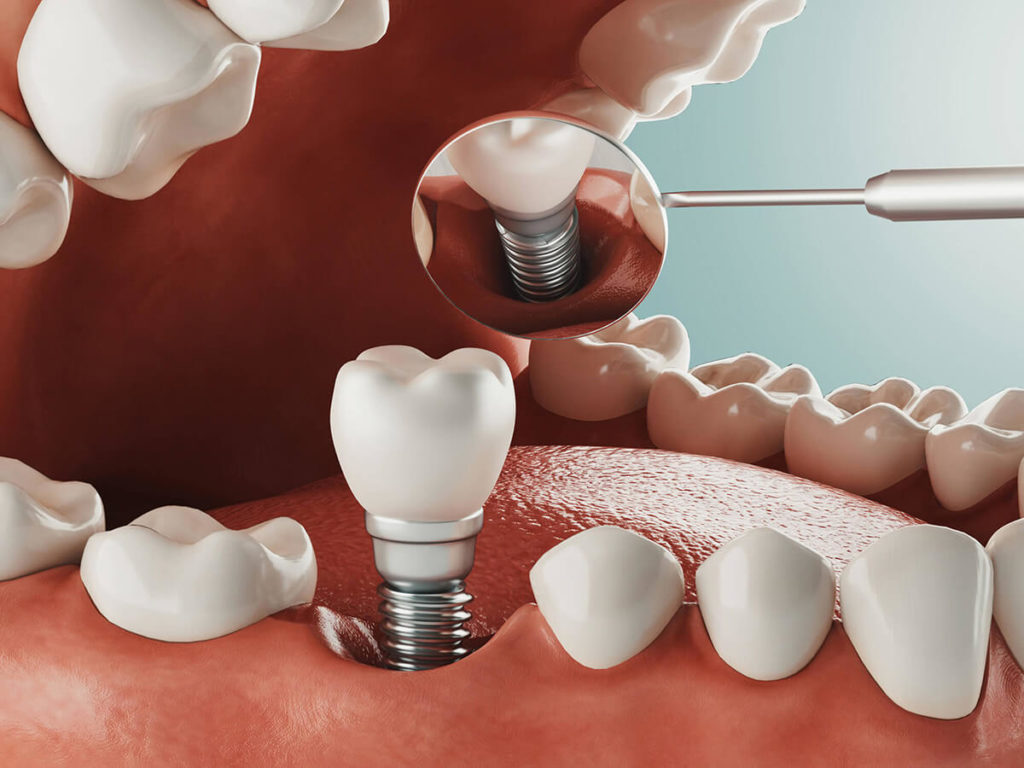 dental implants ashburn va