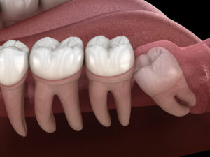 illustration of an impacted wisdom tooth that requires removal