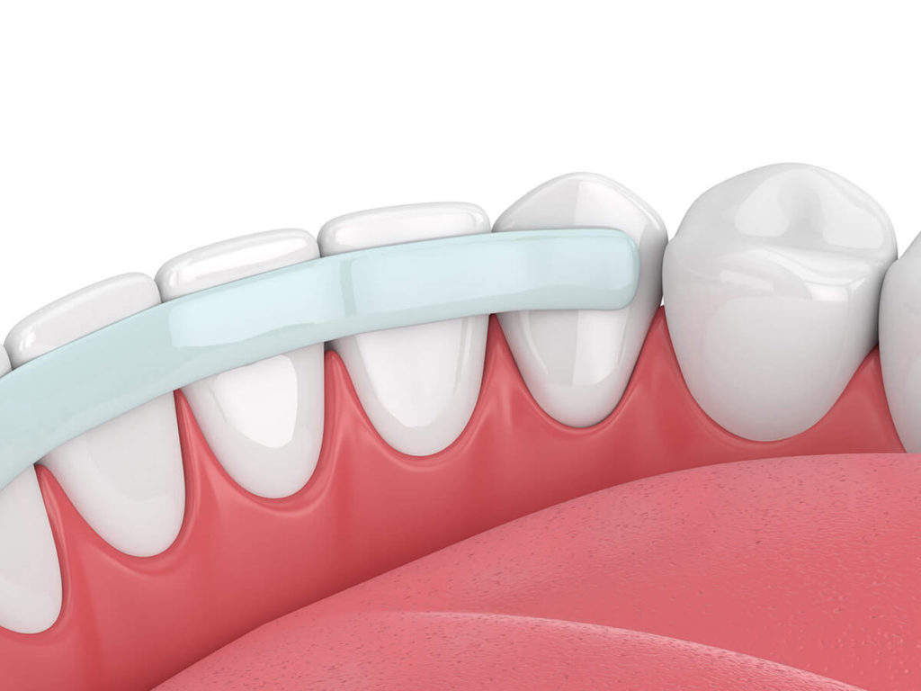 illustration of a bottom row of teeth with dental bonding attached