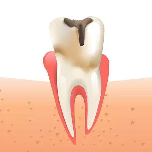 illustration of a tooth with decay, indicating a cavity is present