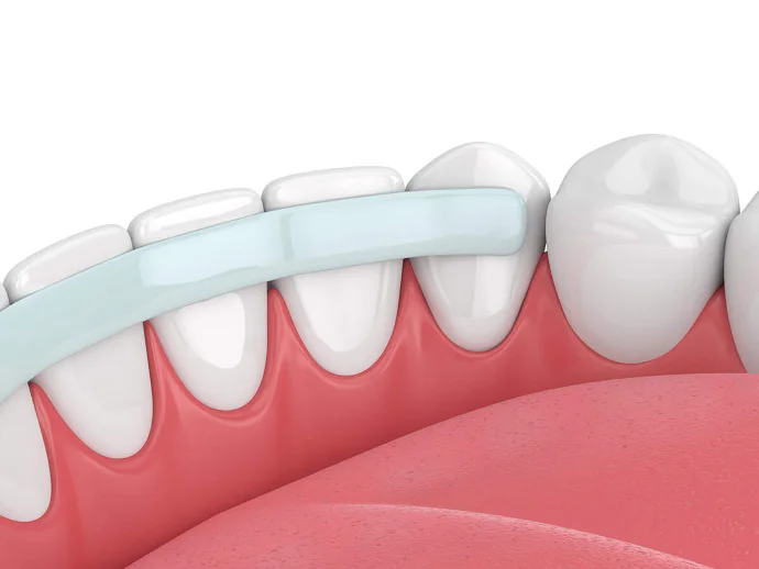 Dental Bonding in Denver, NC at Summit Family Dentistry