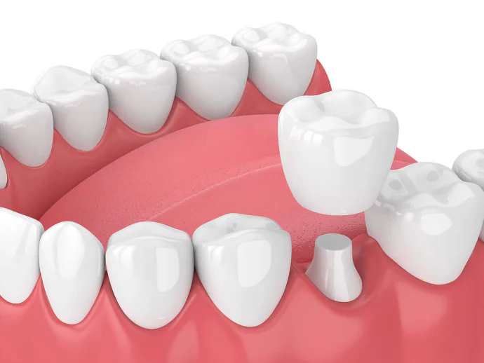 Dental Crowns & Bridges in Denver, NC at Summit Family Dentistry