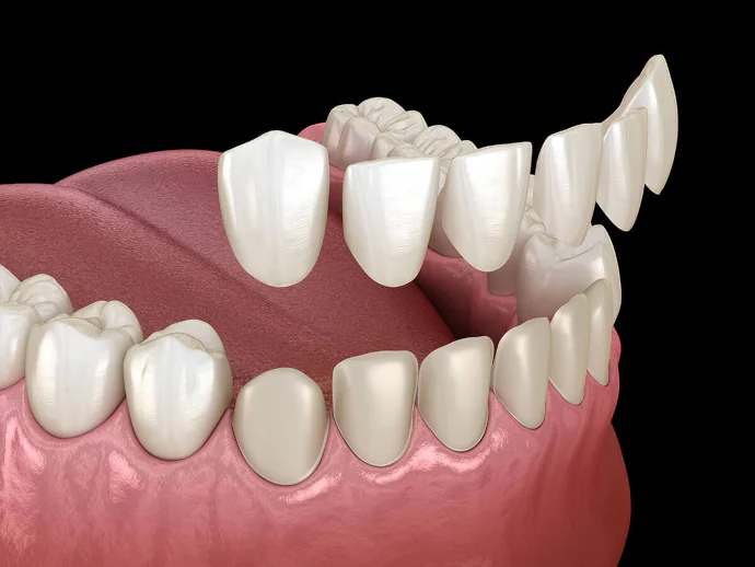 Dental Veneers in Denver, NC at Summit Family Dentistry