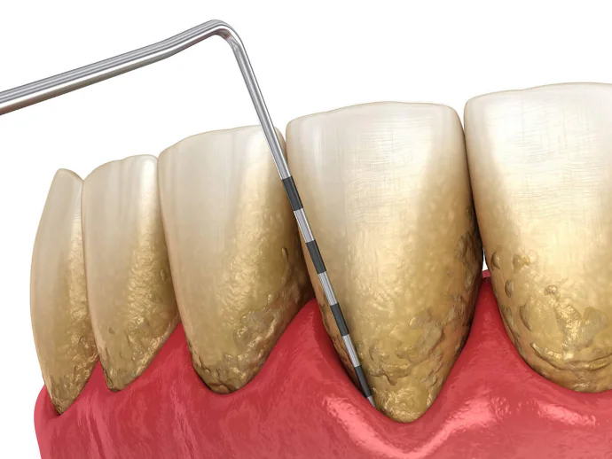 Gum Disease Treatment in Denver, NC at Summit Family Dentistry