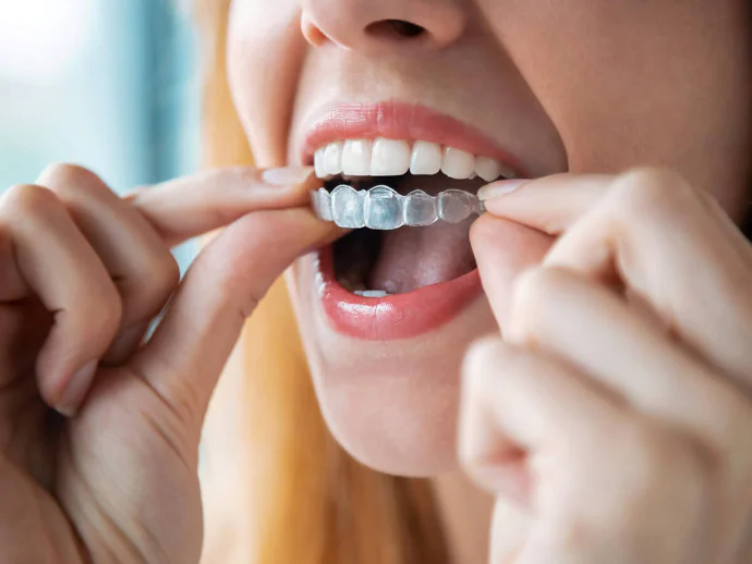 Invisalign in Denver, NC at Summit Family Dentistry