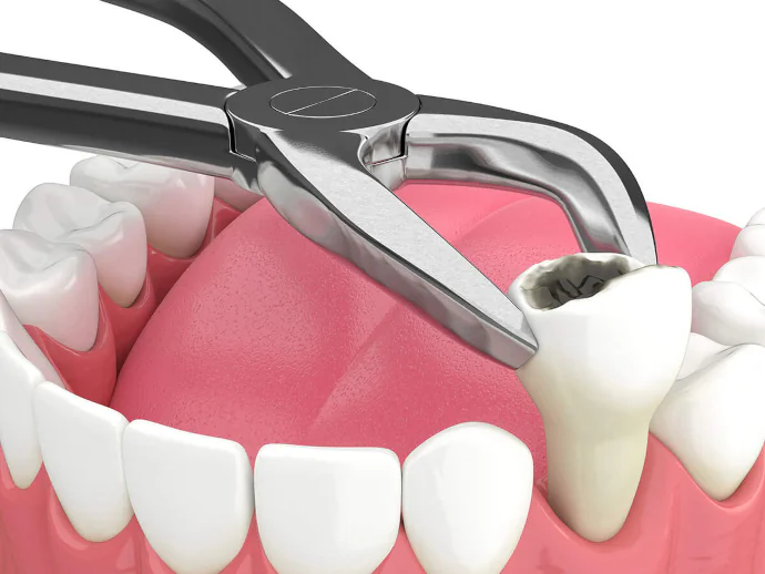 Tooth Extractions in Denver, NC at Summit Family Dentistry