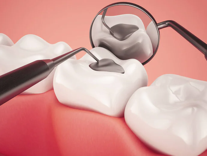 Tooth Fillings & Sealants in Denver, NC at Summit Family Dentistry