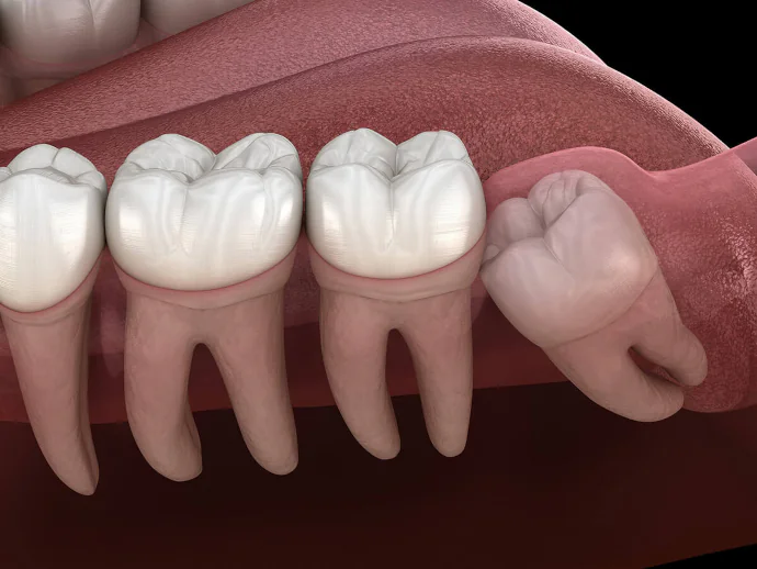 Wisdom Teeth Removal in Denver, NC at Summit Family Dentistry